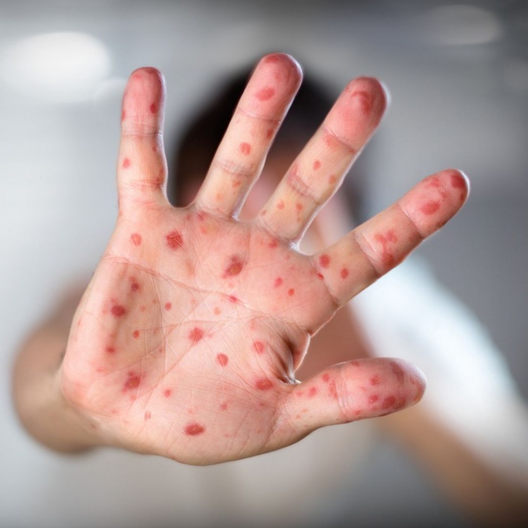 Measles cases rise in Kazakhstan