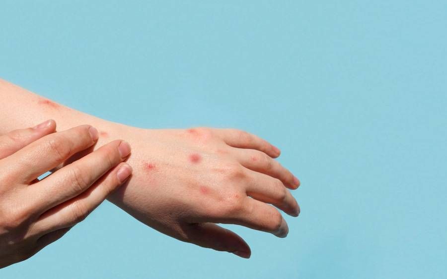 No Monkeypox cases reported in Azerbaijan, Health Ministry confirms